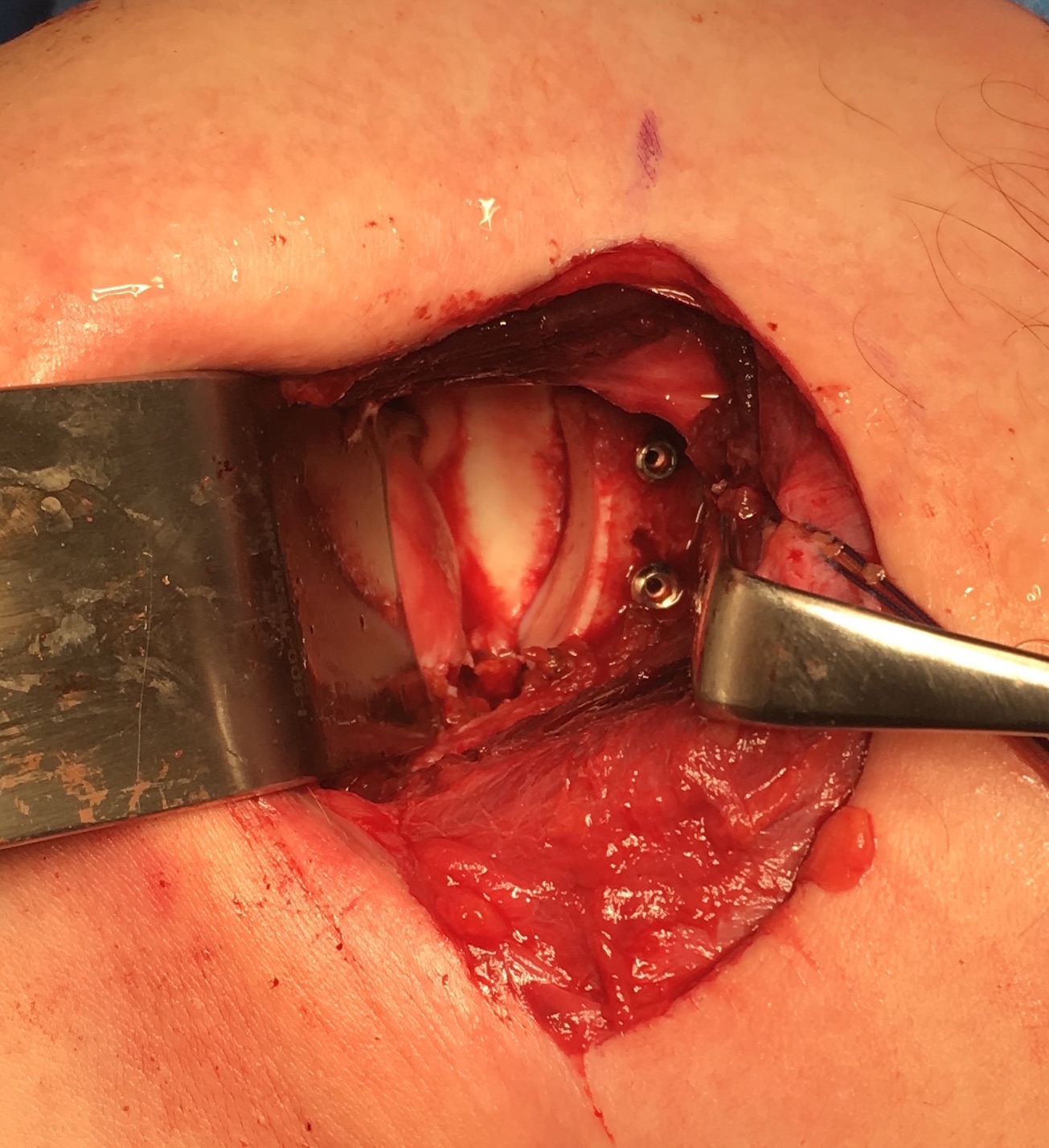 allograft
