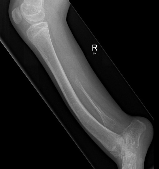 fibular hemimelia