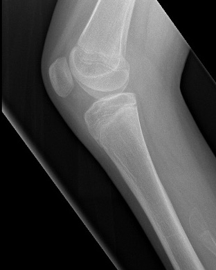 fibular hemimelia