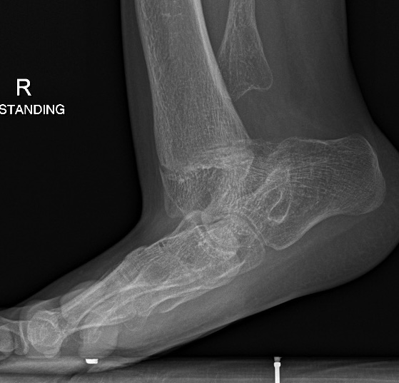 Fibular hemimelia