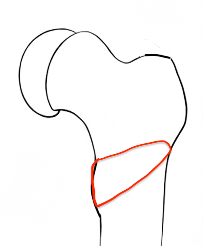 Osteotomy