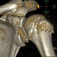 glenoid