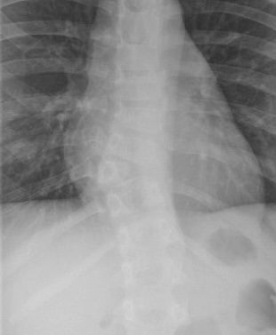 Congenital scoliosis