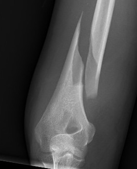 Distal 1/3