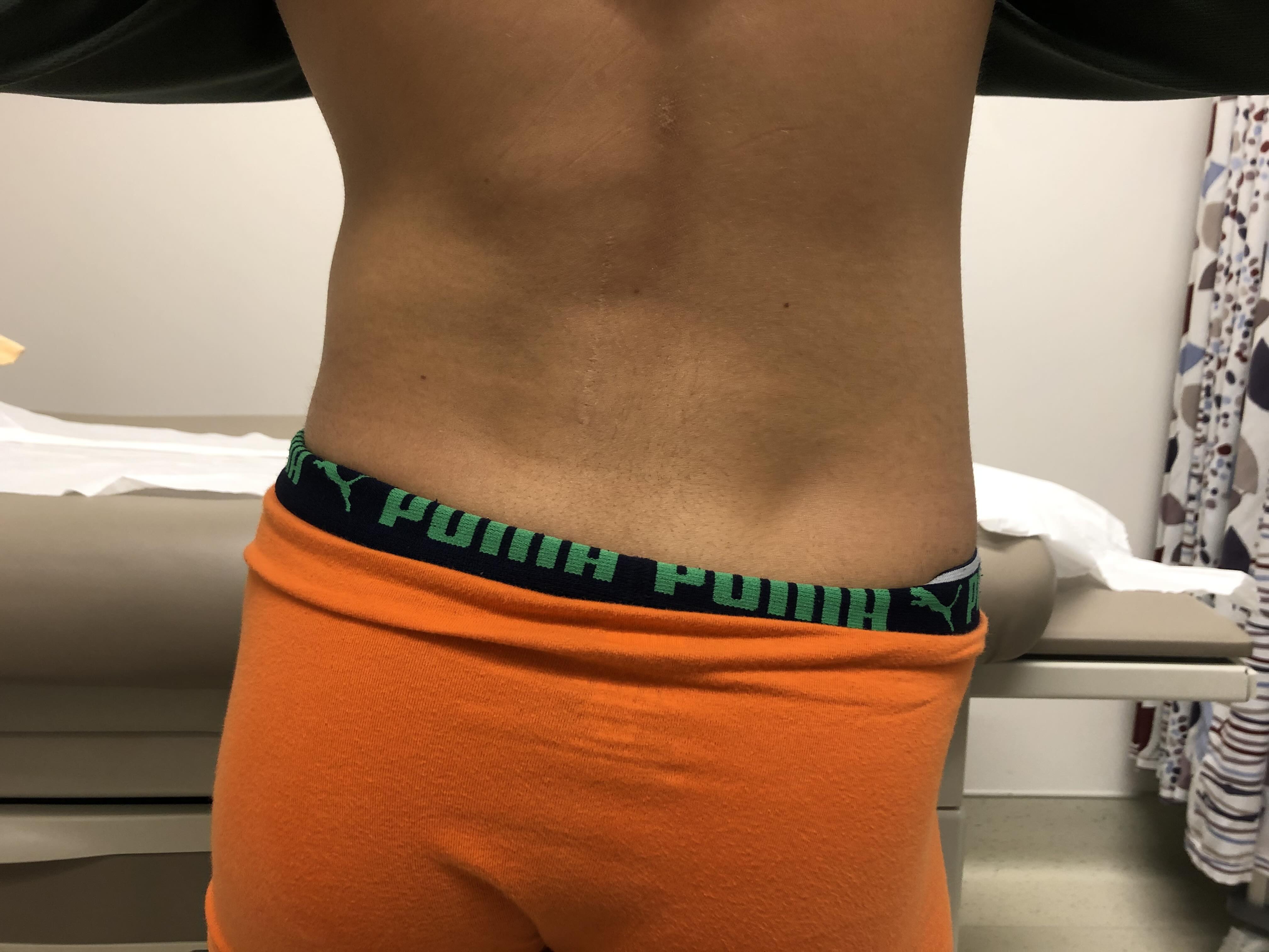Pelvic obliquity