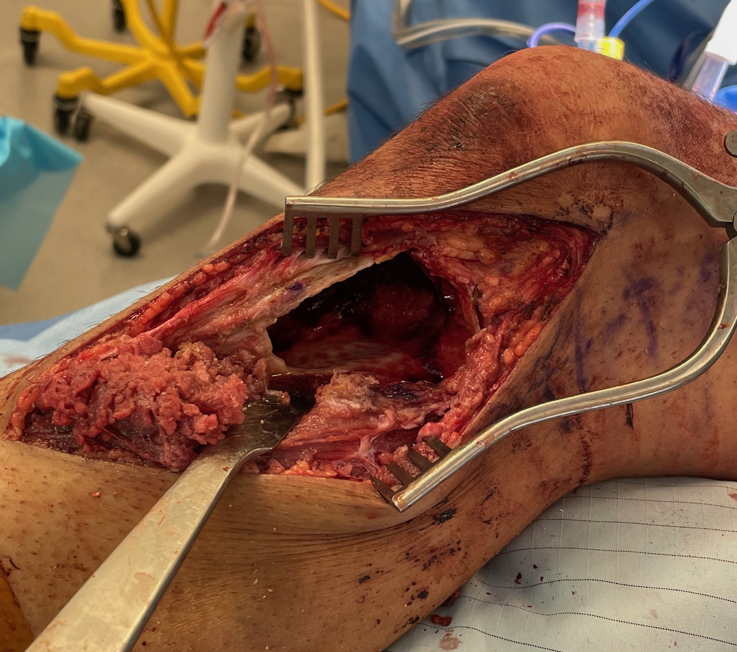 Giant cell tumour