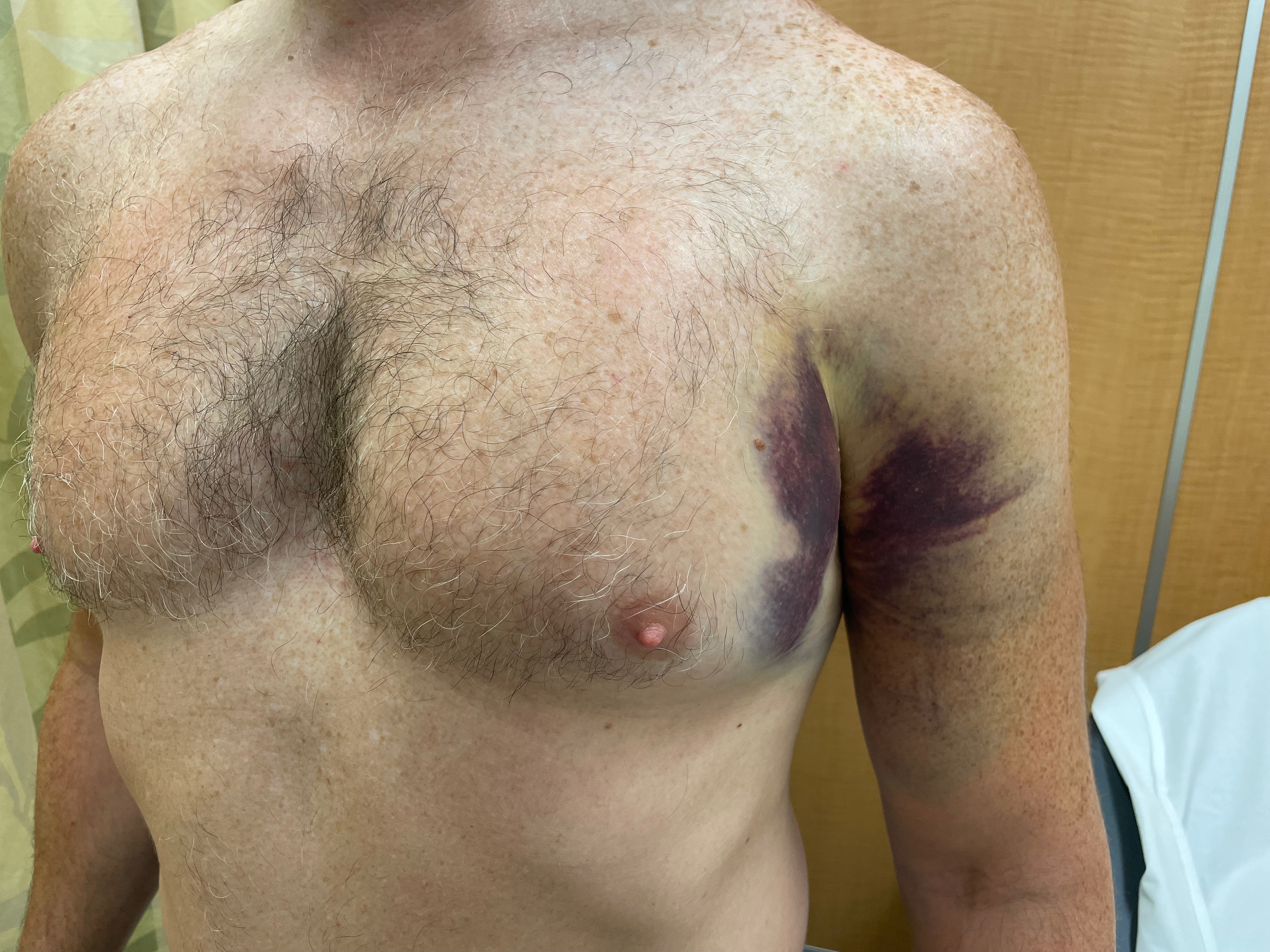 Pec tear