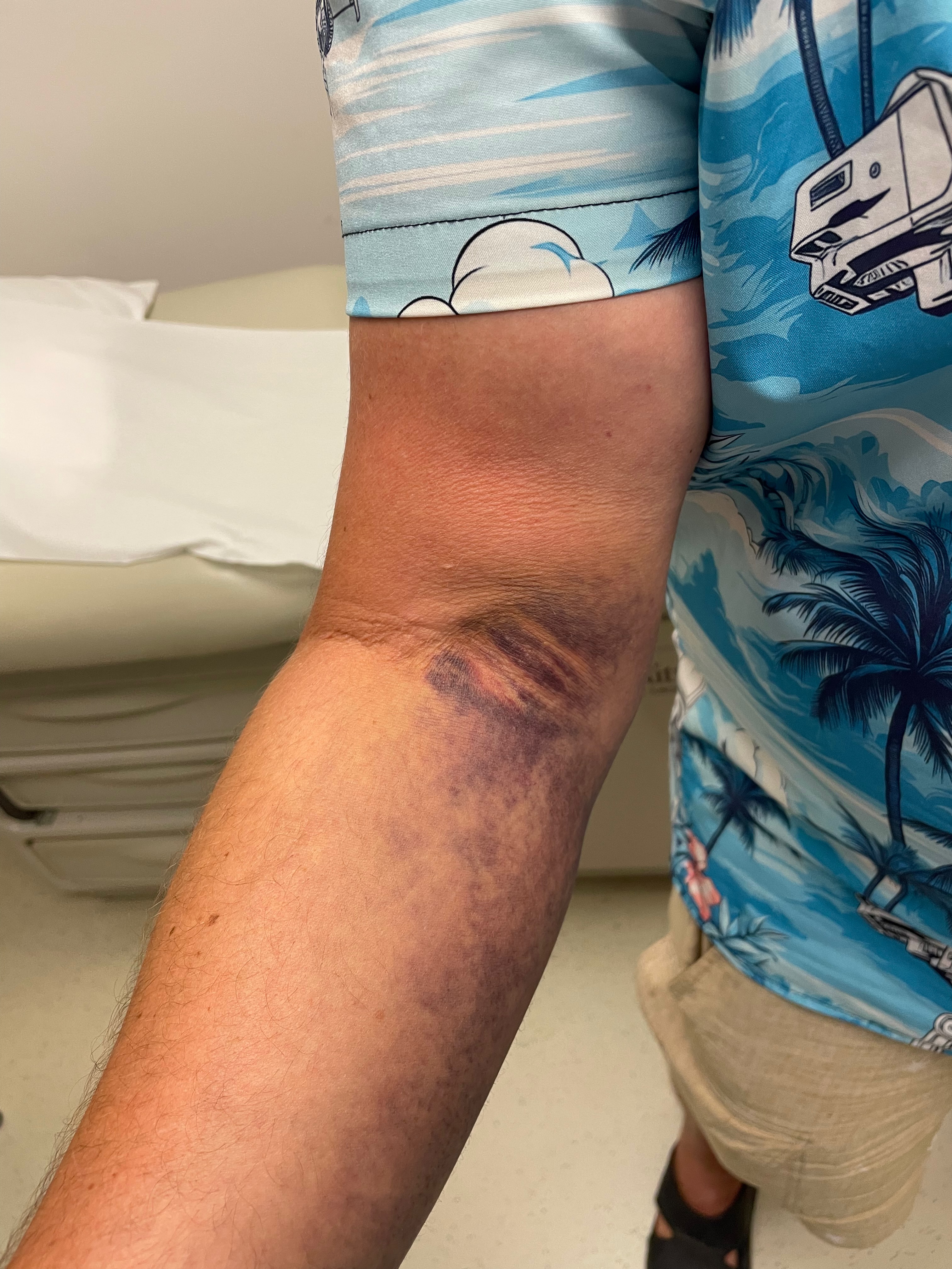 distal biceps