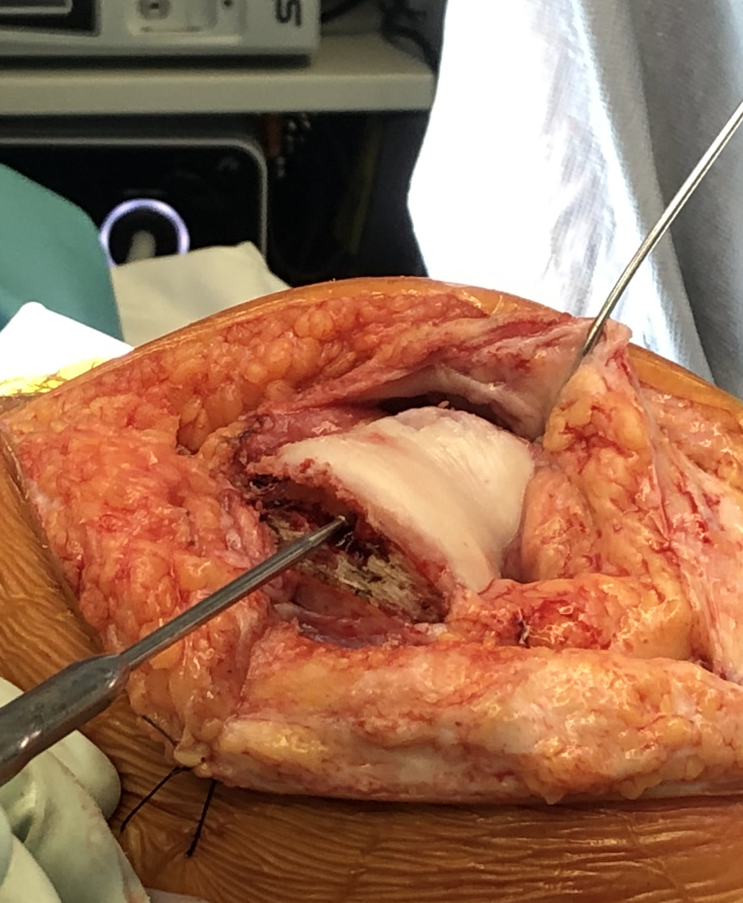 trochleoplasty