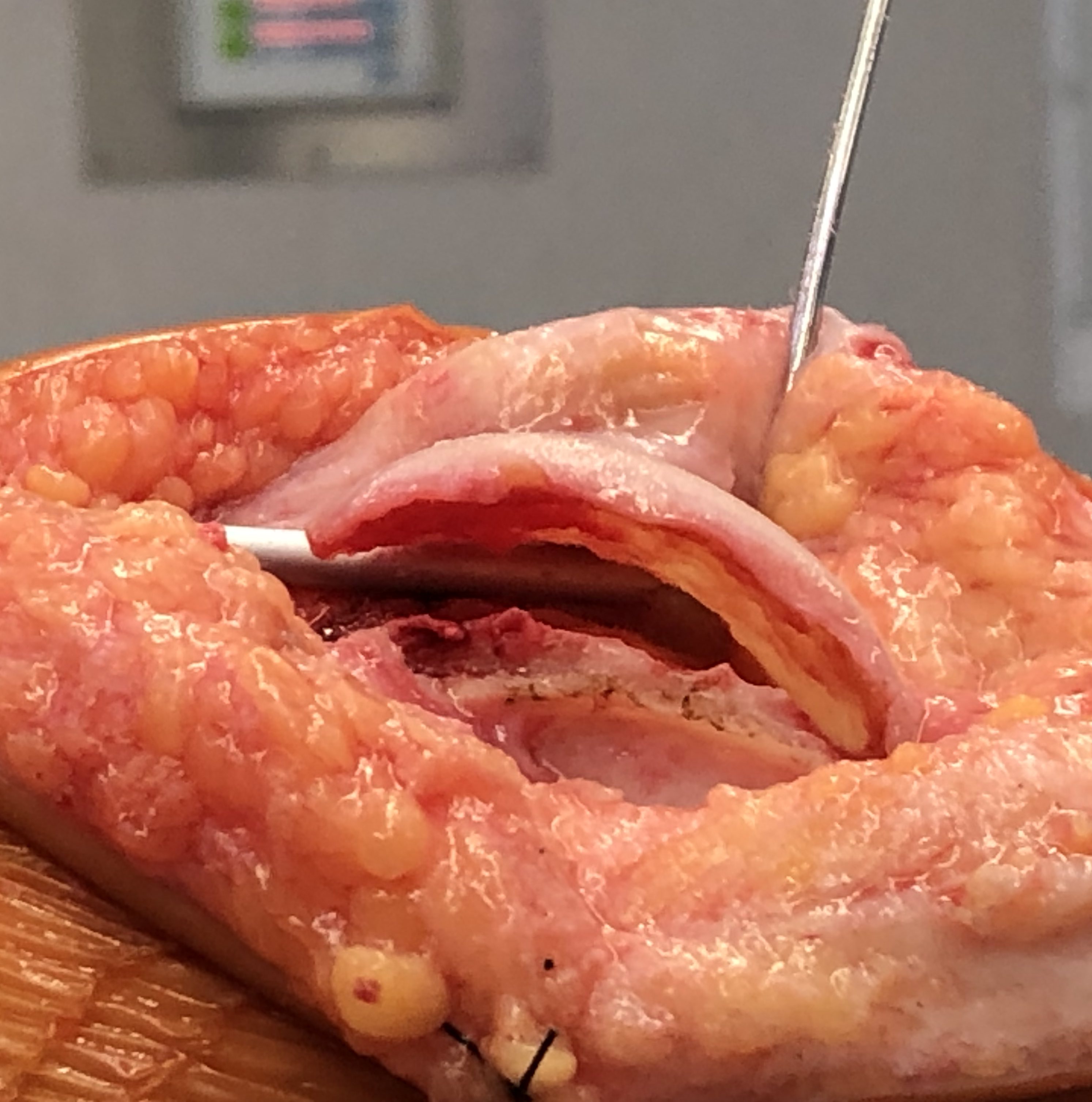 trochleoplasty