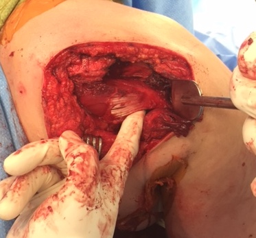 glenoid osteot