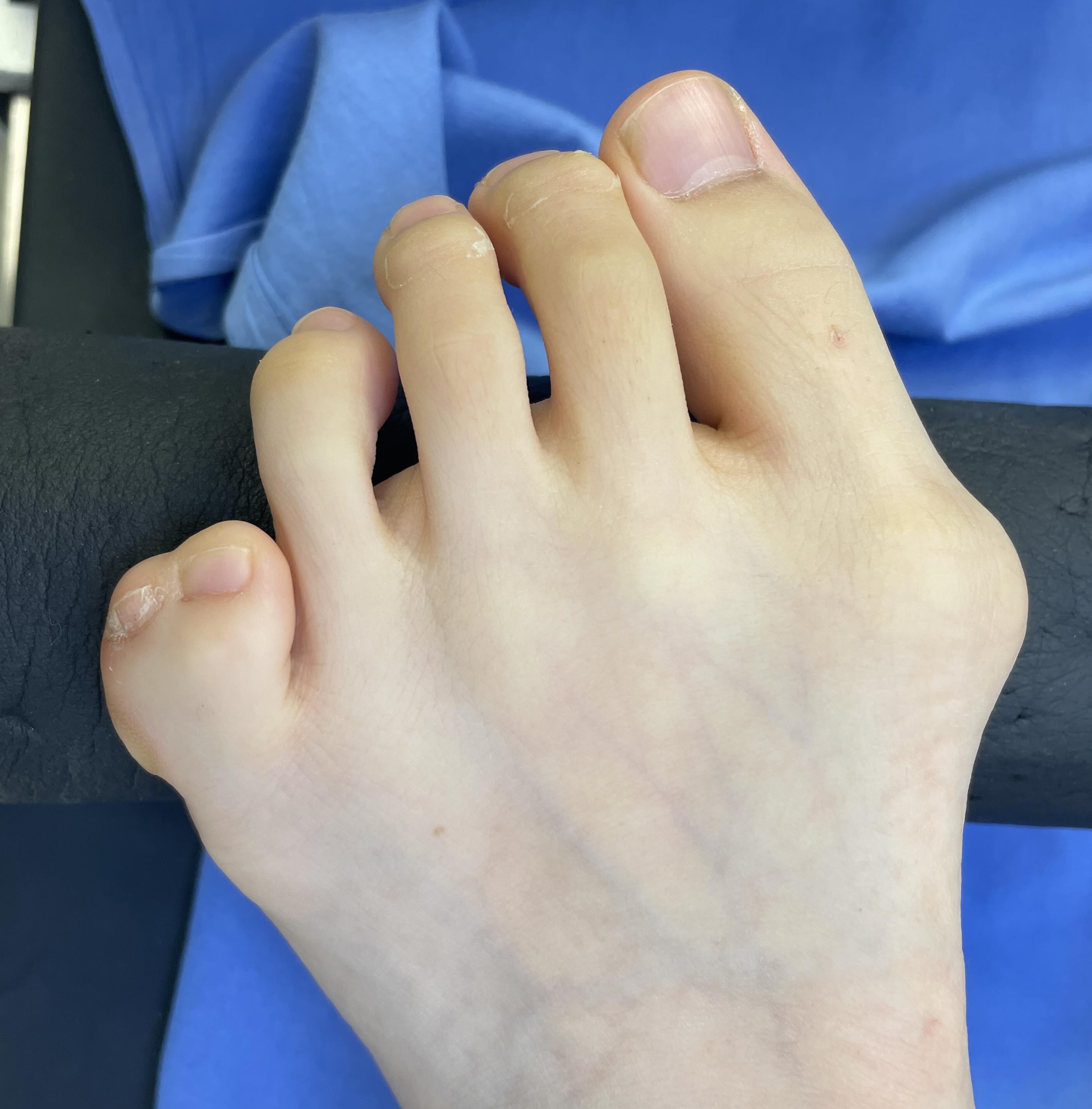 Syndactyly