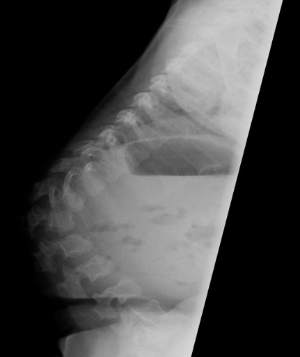 achondroplasia