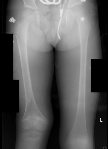 Congenitally short femur