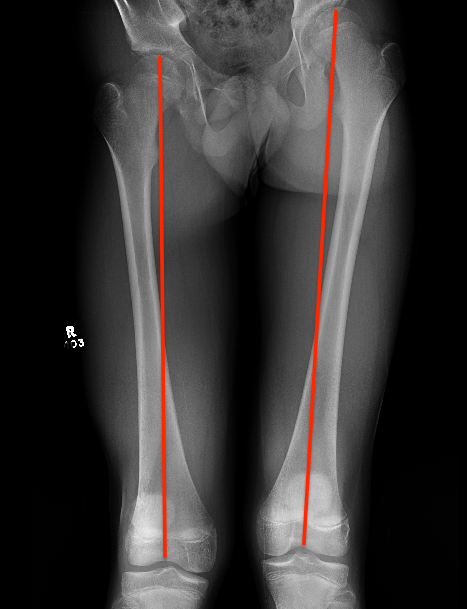 Short femur