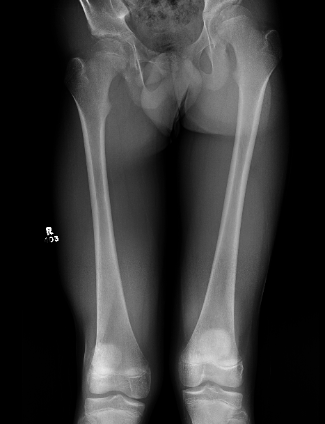 short femur