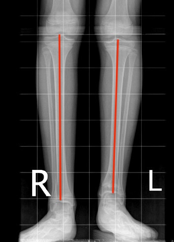 Short tibia