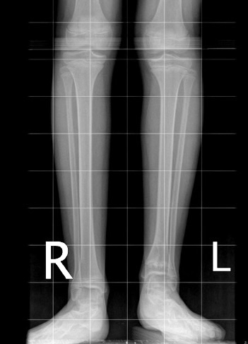 Short tibia