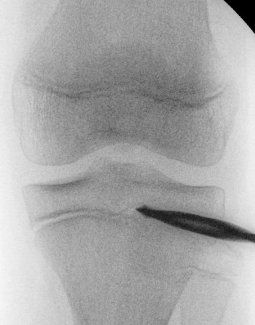 epiphysiodesis