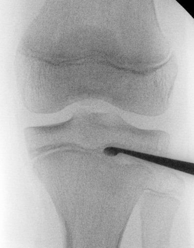 epiphysiodesis