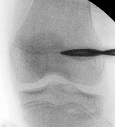 epiphysiodesis