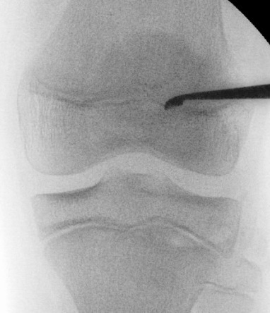 epiphysiodesis