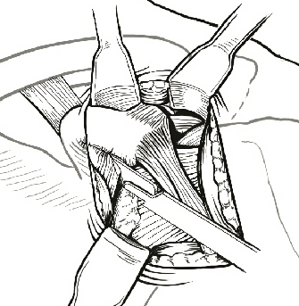 latarjet