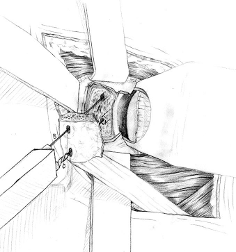 Latarjet