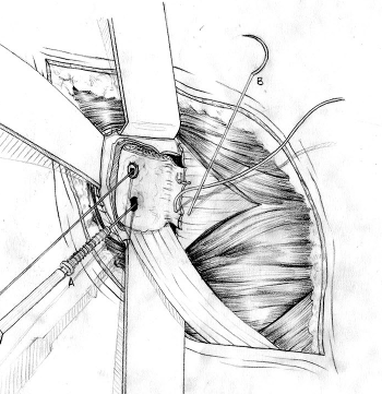 Latarjet