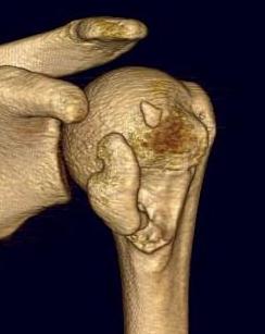 LT fracture