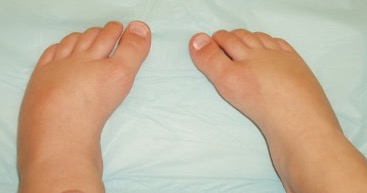 metatarsus varus