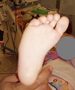 metatarsus varus