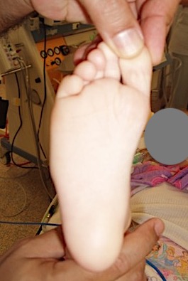 metatarsus varus