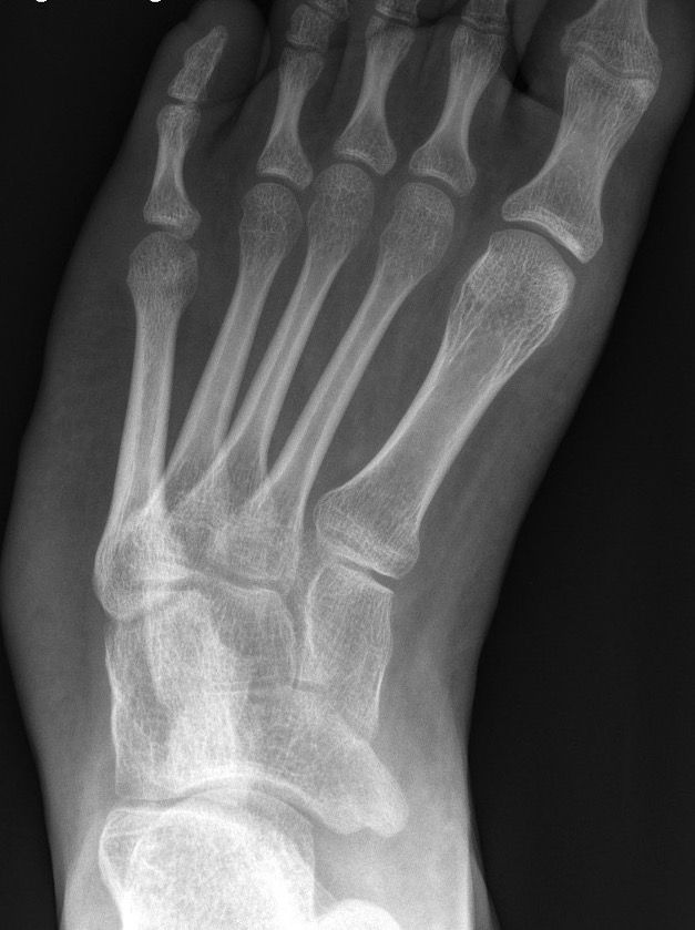 metatarsus varus