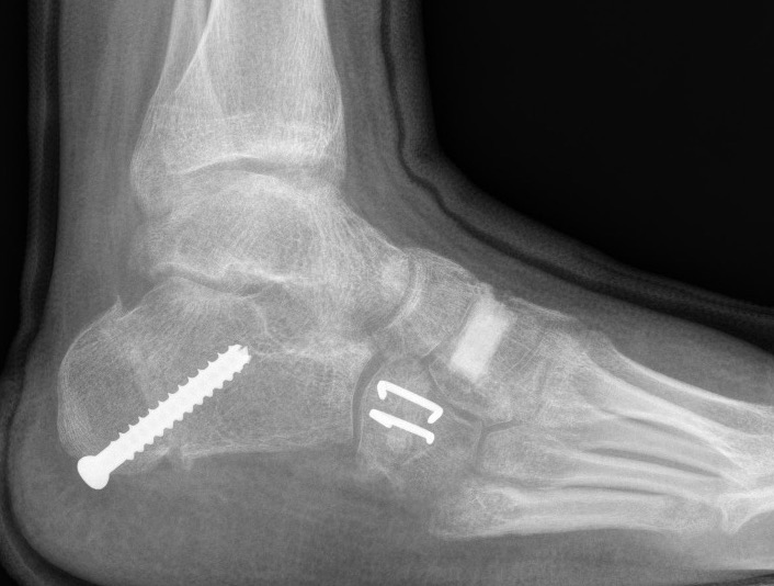 Metatarsus varus