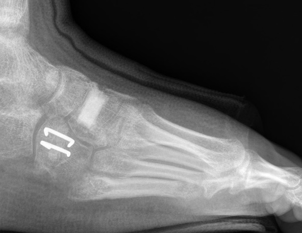 Metatarsus adductus