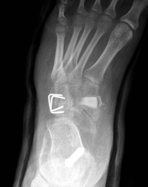 metatarsus varus surg