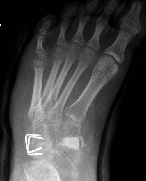 Metatarsus adductus