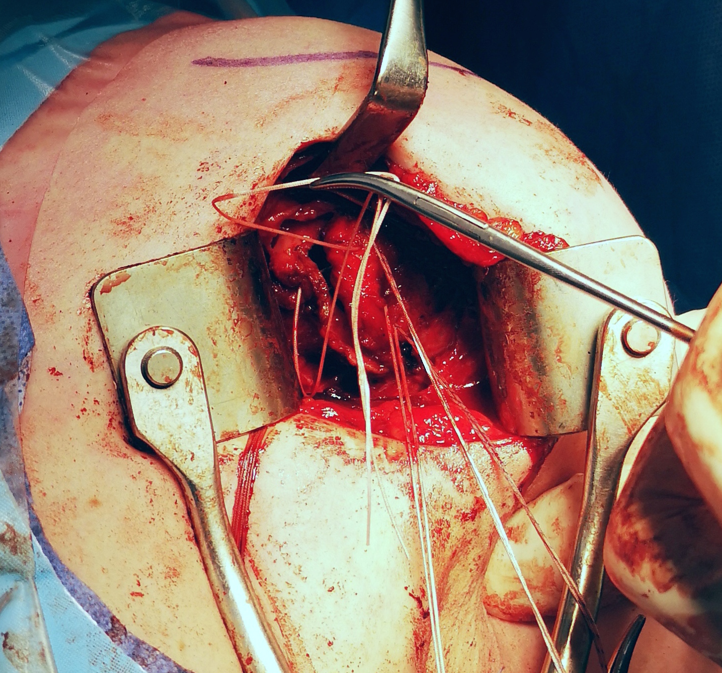 open capsular plication