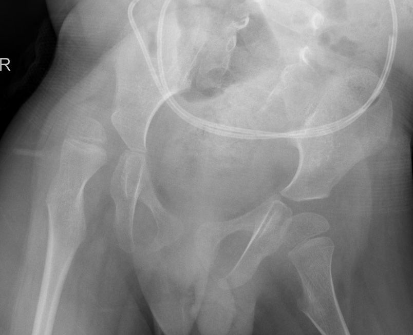 CP hip
