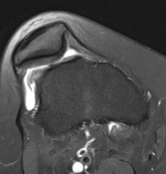 Trochlea dysplasia