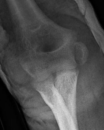 Medial epi