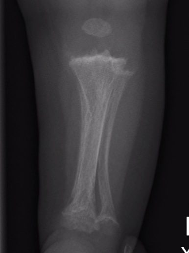 metaphyseal chondrodysplasia
