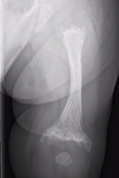 metaphyseal chondrodyplasia
