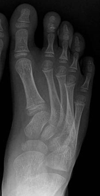 metatarsus varus