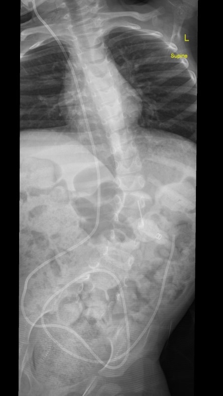 NM scoliosis