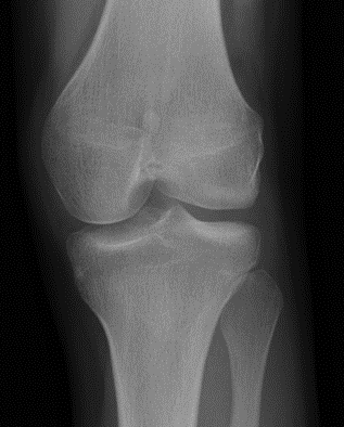 Nail patella syndrome