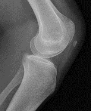 Nail patella syndrome