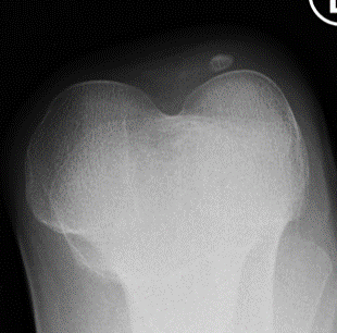 Nail patella syndrome
