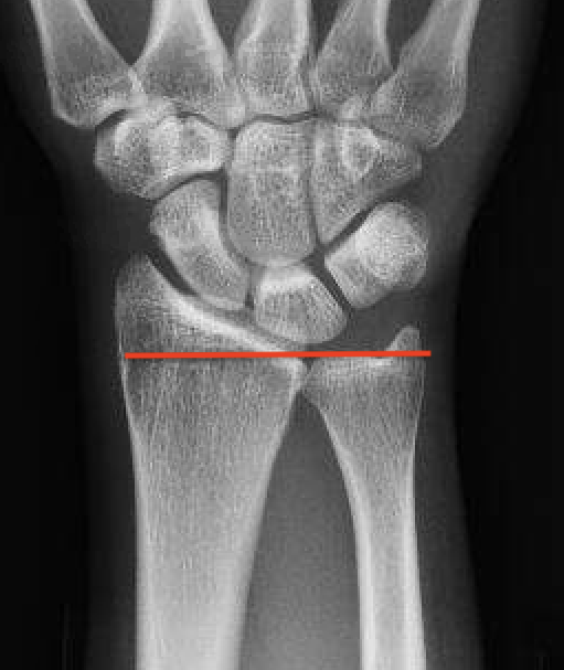 ulna